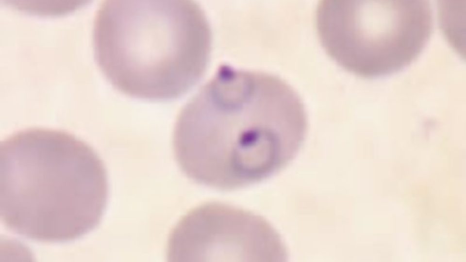 Krev pacienta nakaženého malárií. Nachově zbarvené kuličky jsou červené krvinky o průměru zhruba 5 mikrometrů. Jedna z nich je napadená parazitem způsobujícím nejzávažnější formu malárie – Plasmodium falciparum.