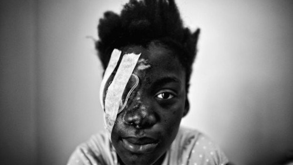 Haiti, 2010. Zraněné děvčátko po zemětřesení