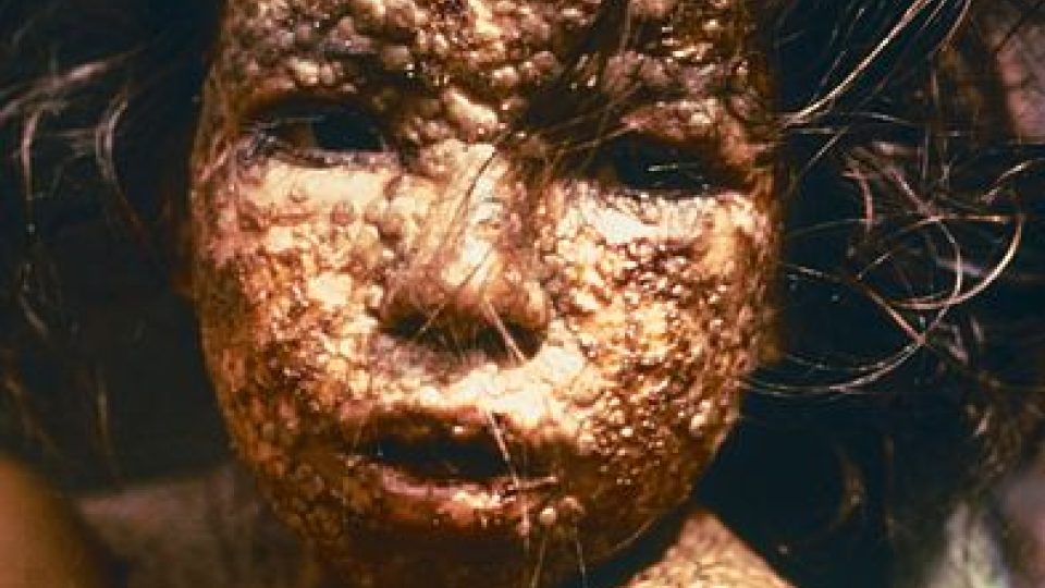 Dítě s neštovicemi