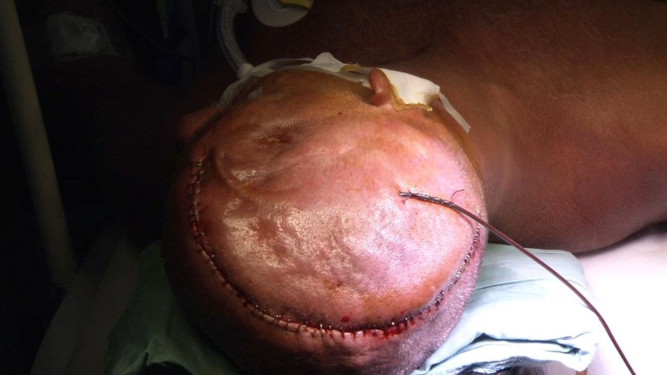Lékaři v Ústí nad Labem nahradili pacientovi část lebky titanovým implantátem
